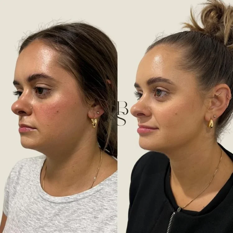 Sculptd HIFU before and after