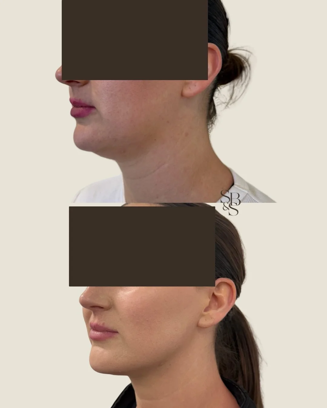 Sculptd HIFU before and after, chin and jawline