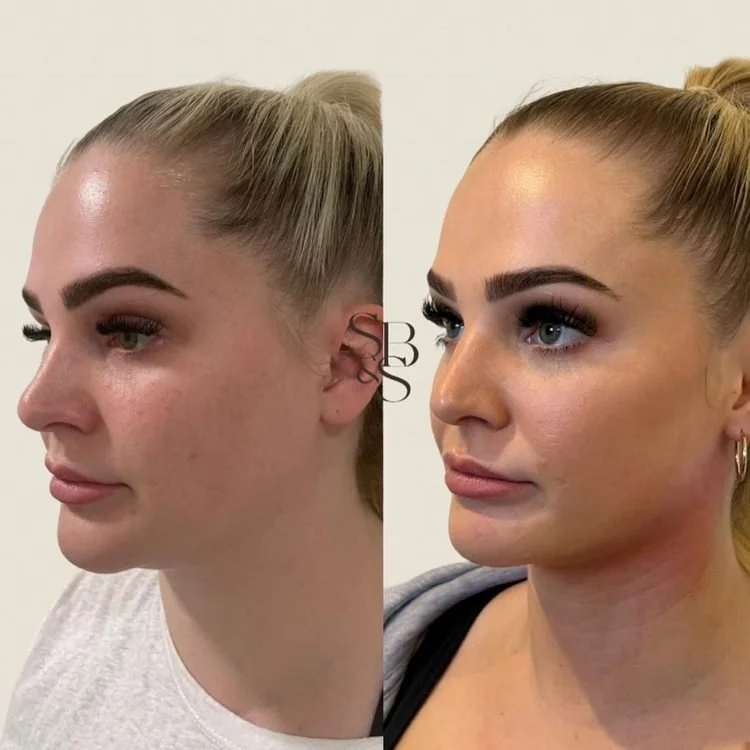 Sculptd HIFU before and after