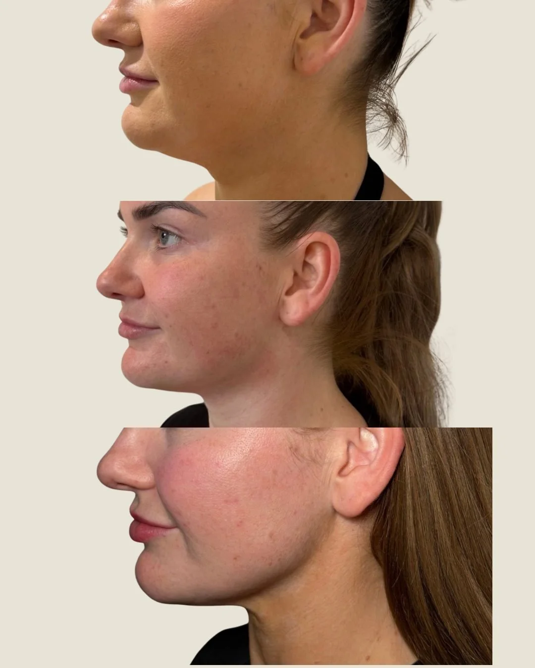Sculptd HIFU before and after, jawline across three sessions