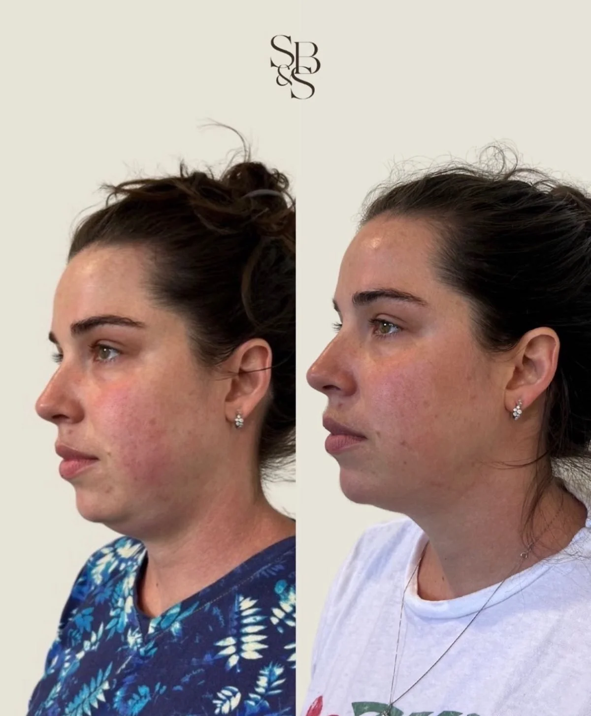 Sculptd HIFU before and after, double chin and jawline