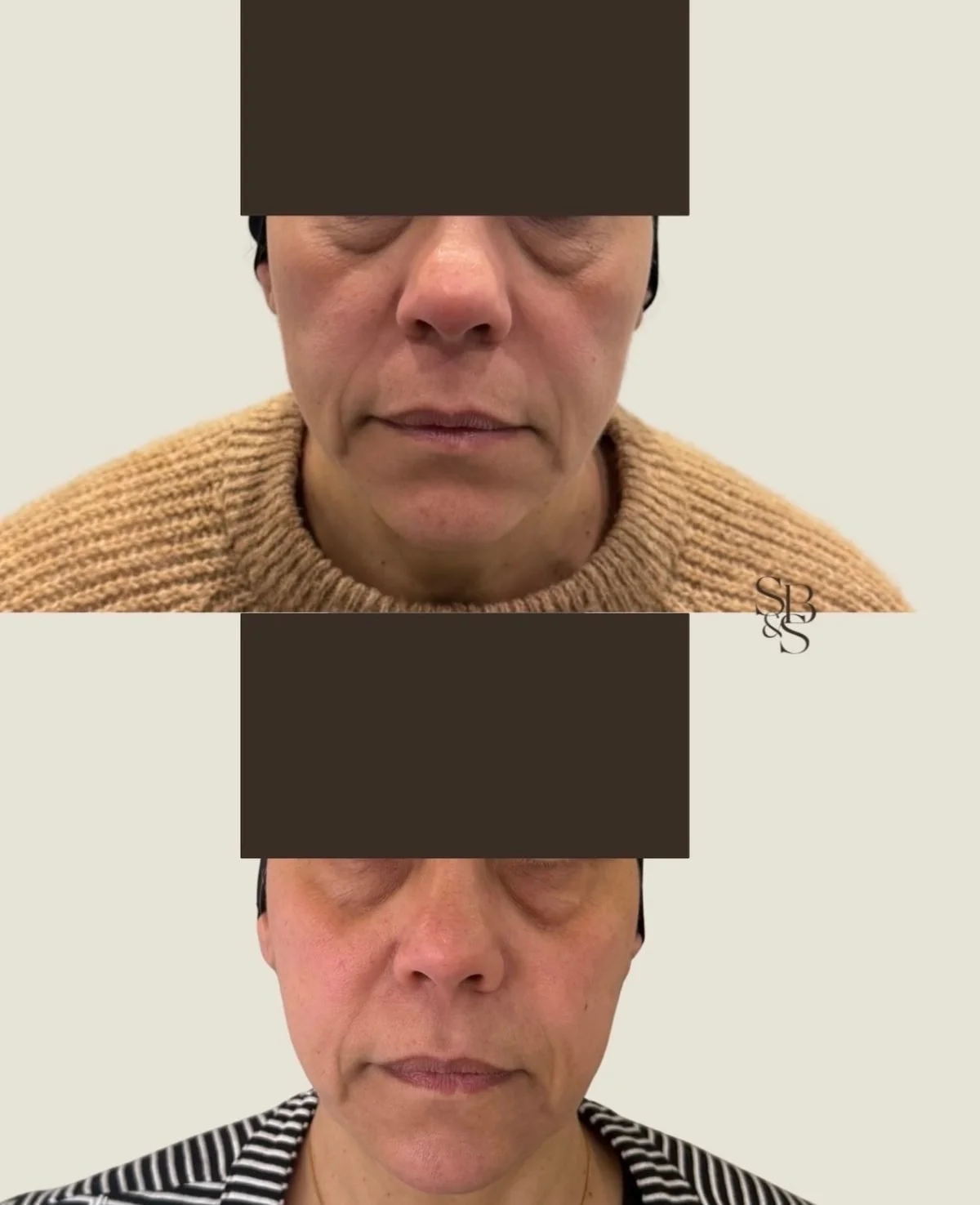 Sculptd HIFU before and after, lower face