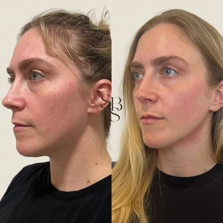 Sculptd HIFU before and after