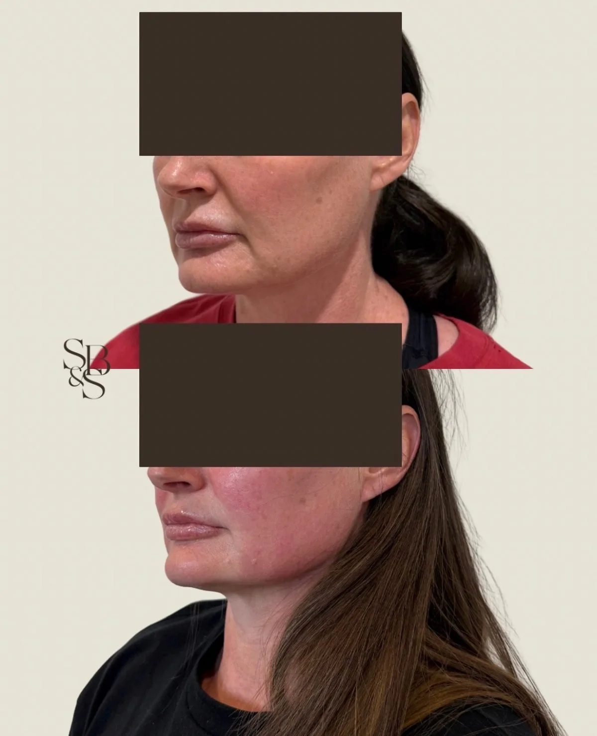 Sculptd HIFU before and after, jawline and lower face