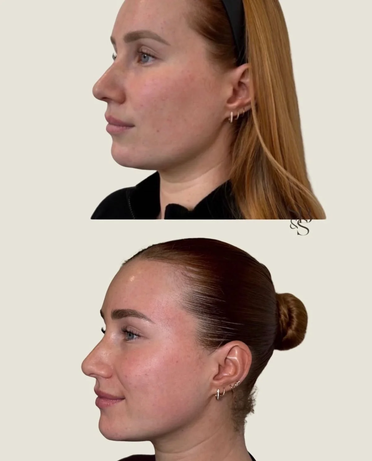 Sculptd HIFU before and after, jawline