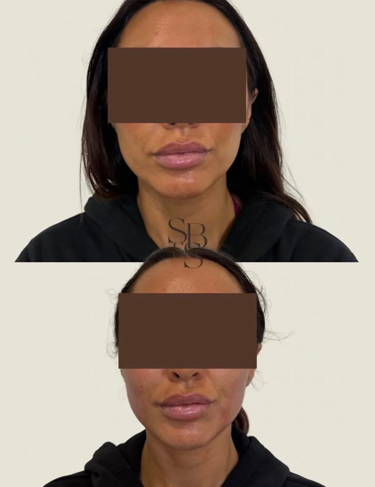 Sculptd HIFU before and after, lower face and jawline