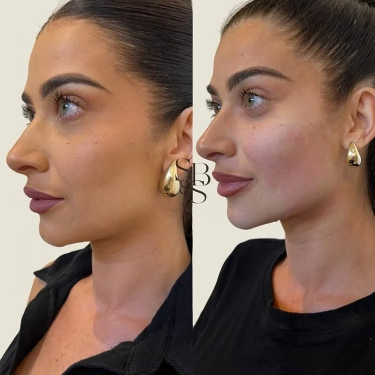 Sculptd HIFU before and after