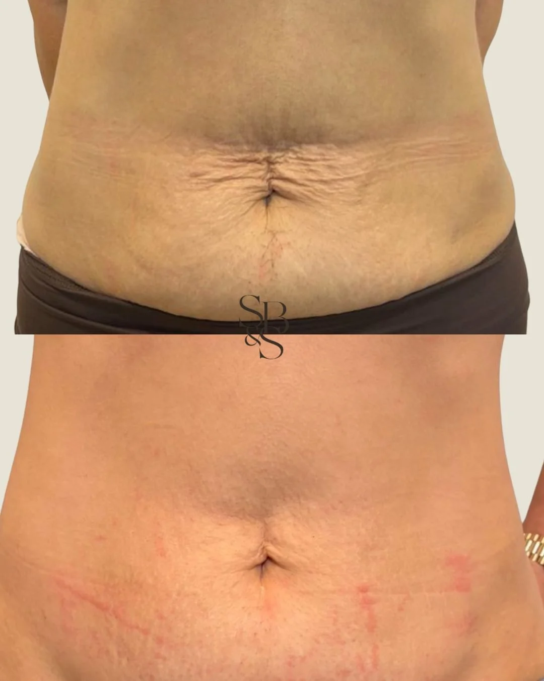 Sculptd HIFU before and after, tummy skin tightening