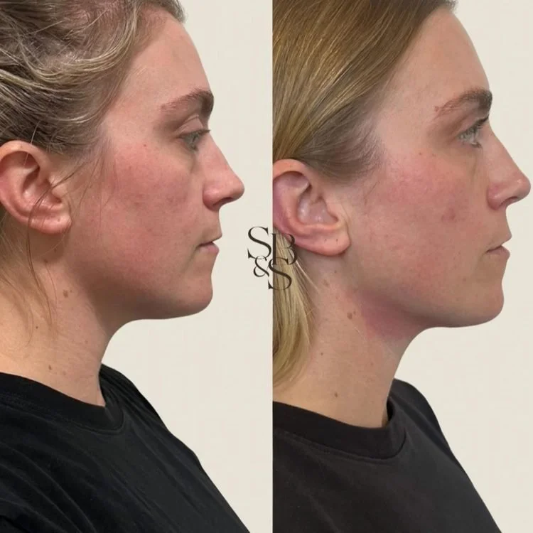 Sculptd HIFU before and after