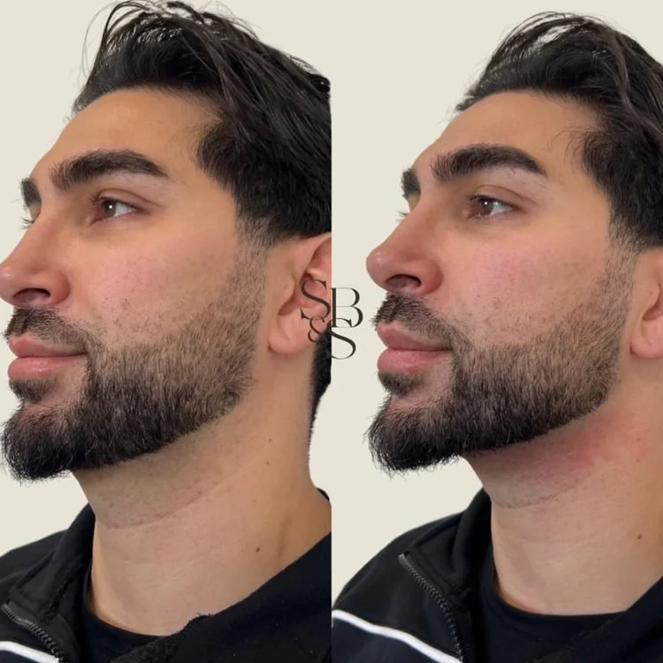 Sculptd HIFU before and after