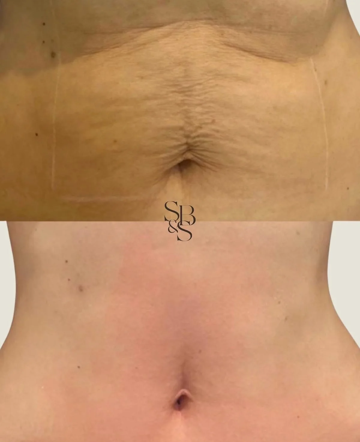 Sculptd HIFU before and after, tummy skin tightening