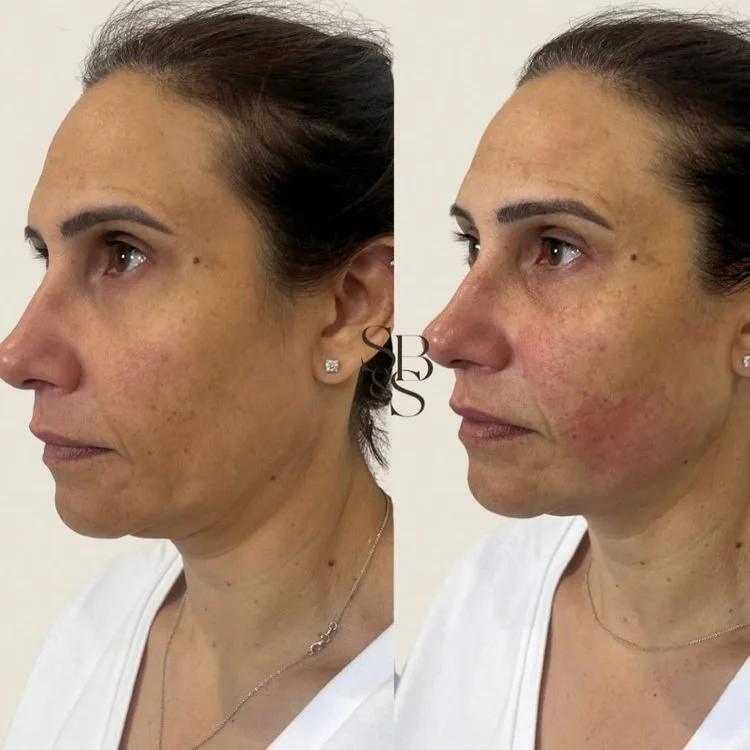 Sculptd HIFU before and after