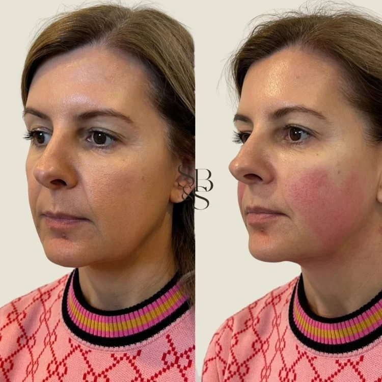 Sculptd HIFU before and after