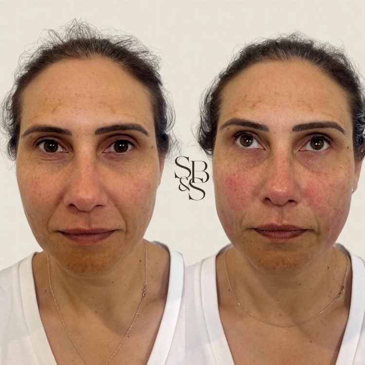 Sculptd HIFU before and after