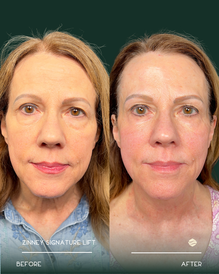 Emface Before and After Result 1
