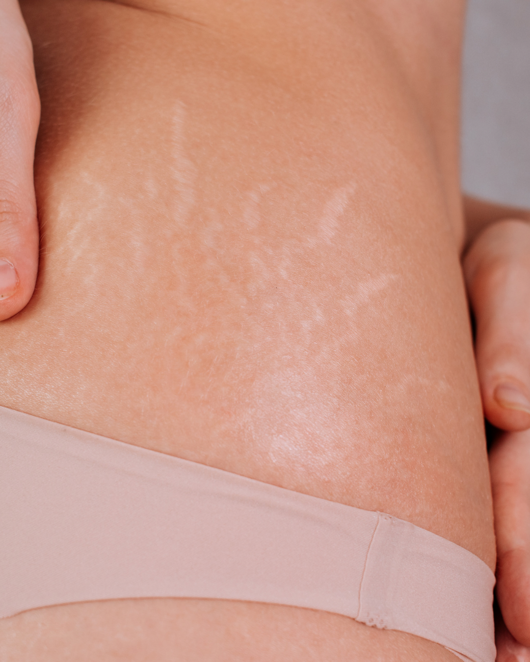 Stretch Mark Treatment