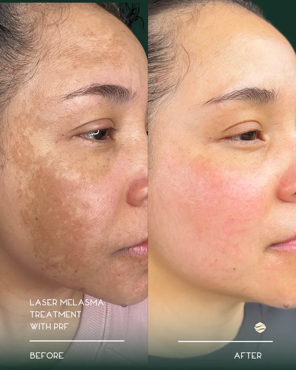 Melasma Before and After 1