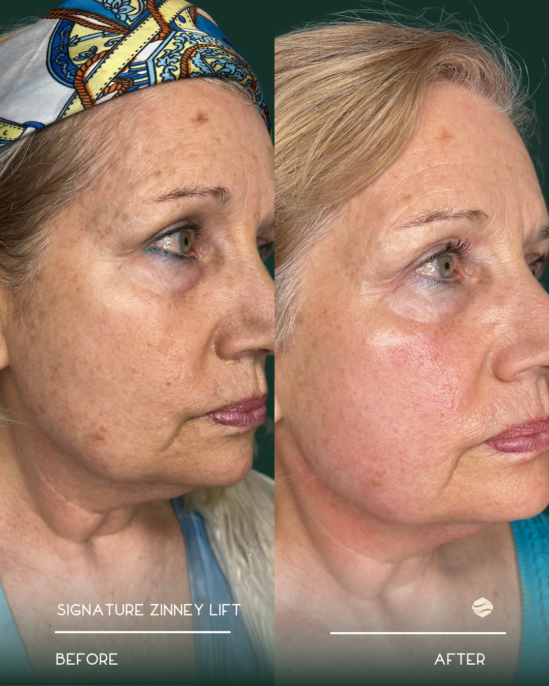 Before and After 6