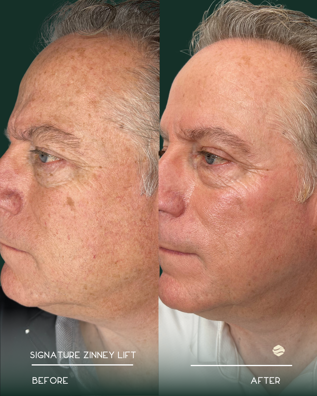 Before and After 8