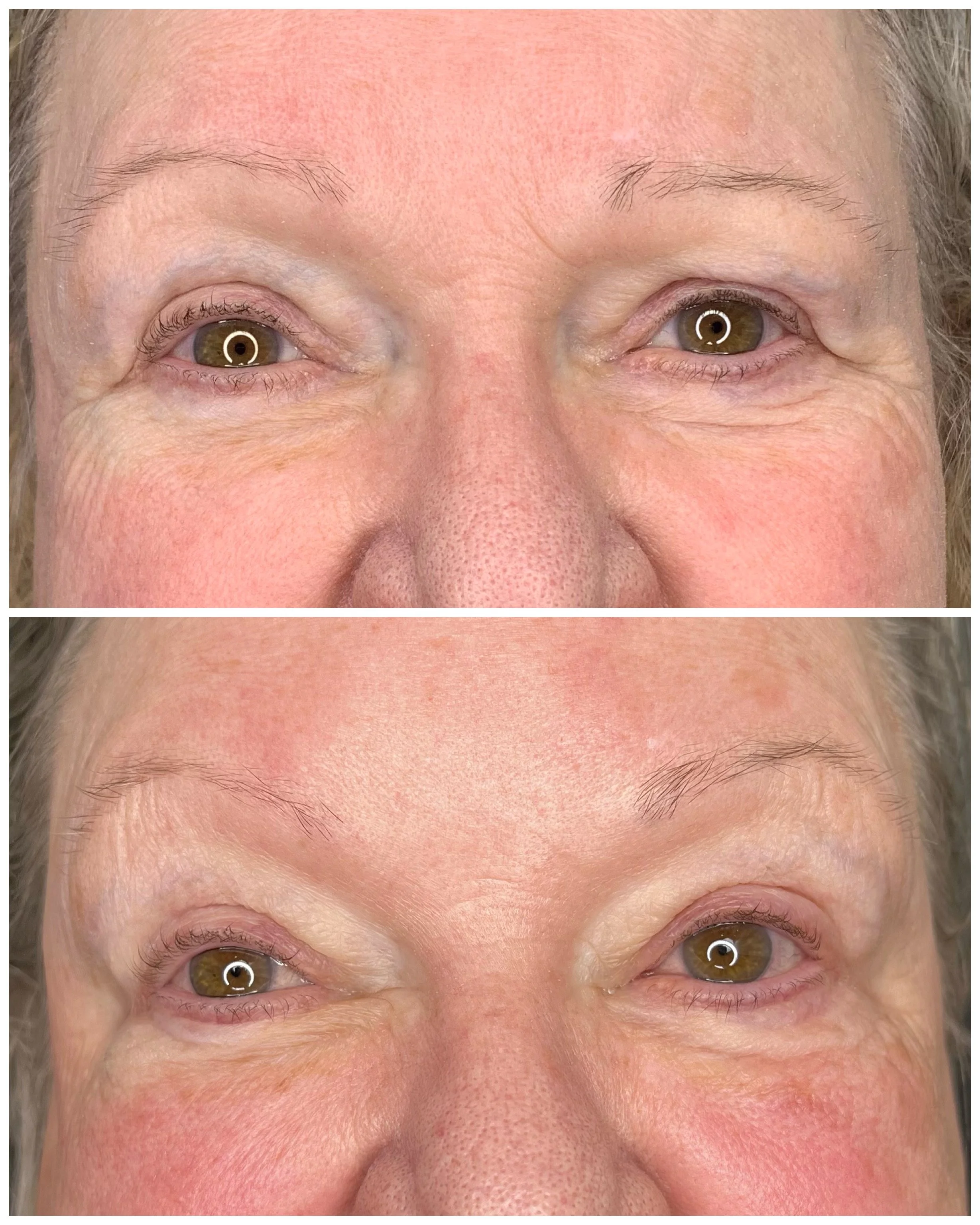 EyeLase Before and After
