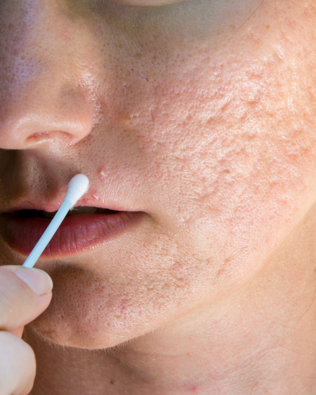 Laser Treatment for Acne Scars