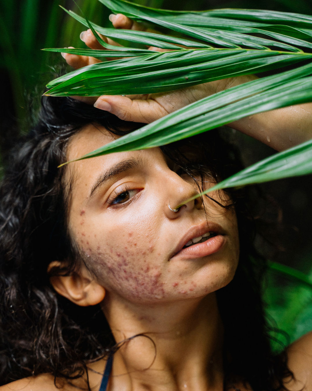 Laser Acne Treatment