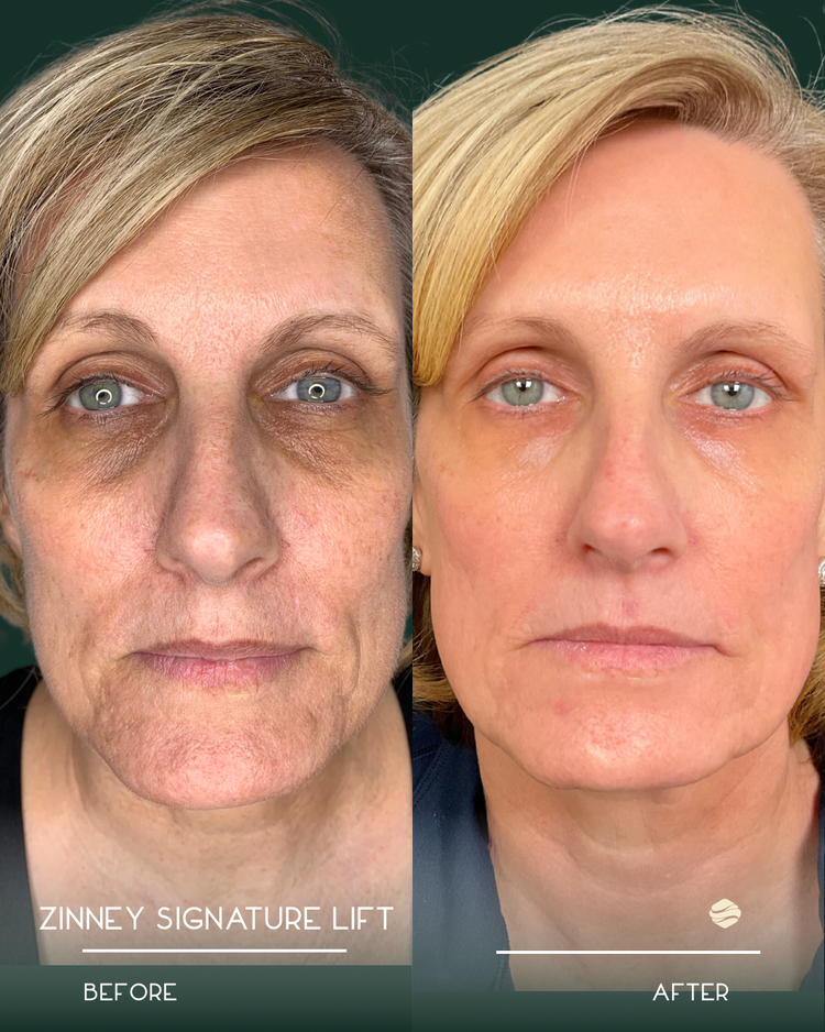 Emface Before and After Result 2