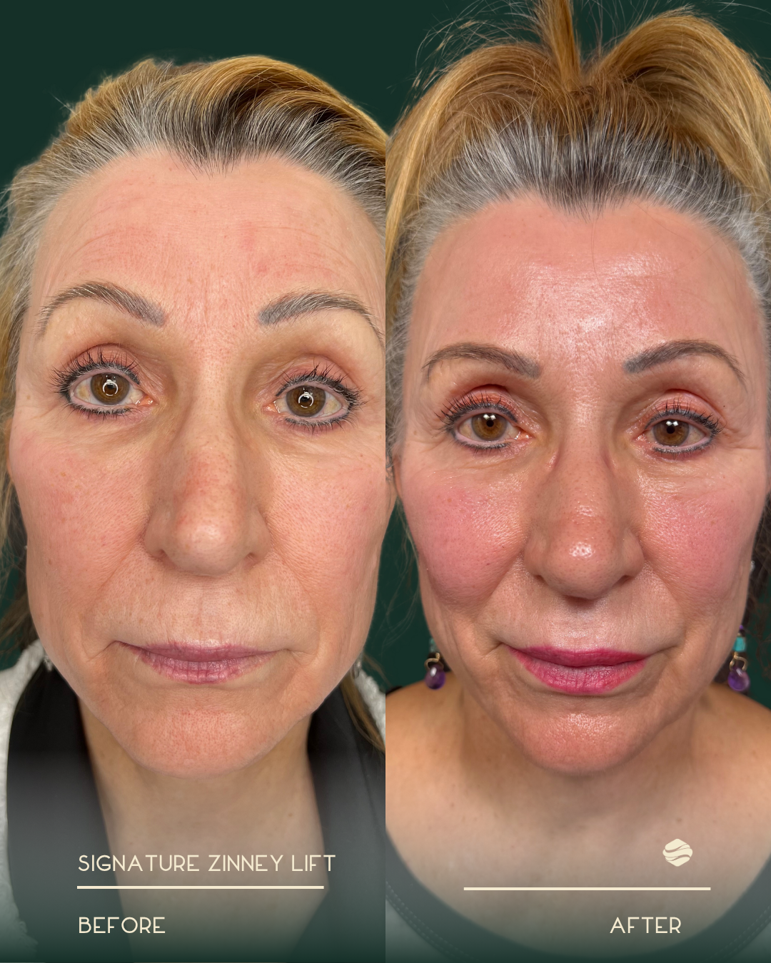 Before and After 3