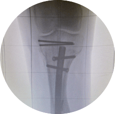 Tibia or plate imaging with OrthoAlignment X-Ray Grid