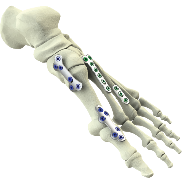 MoRe foot and ankle product illustration