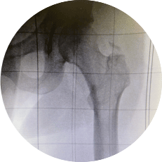 Hip imaging with OrthoAlignment X-Ray Grid