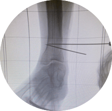 Ankle imaging with OrthoAlignment X-Ray Grid