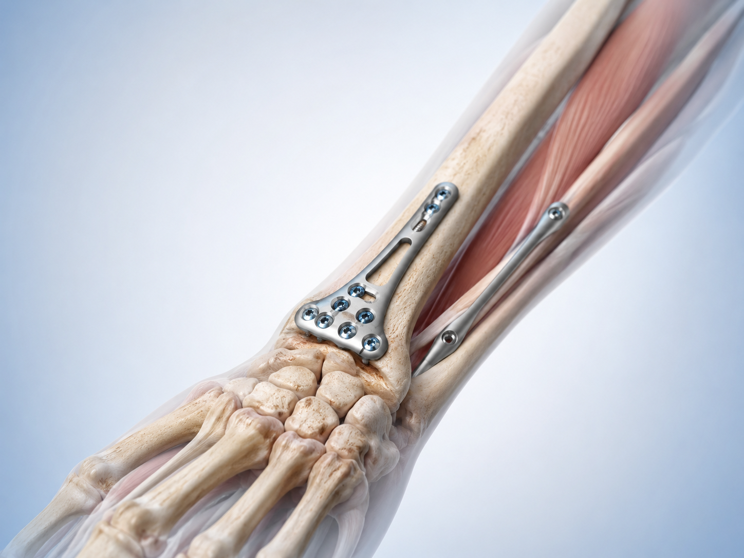 Upper extremity ALM implant
