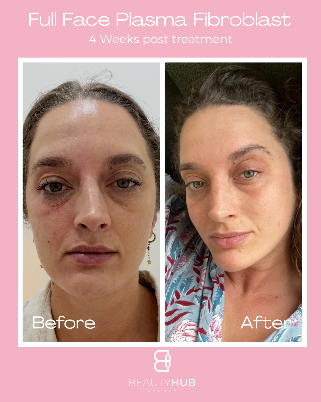 Plamere® fibroblast improvement after 4 weeks.