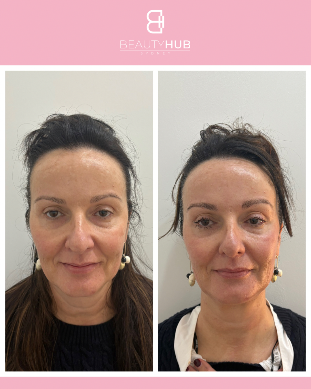 Under chin tightening Liftera HIFU Sydney