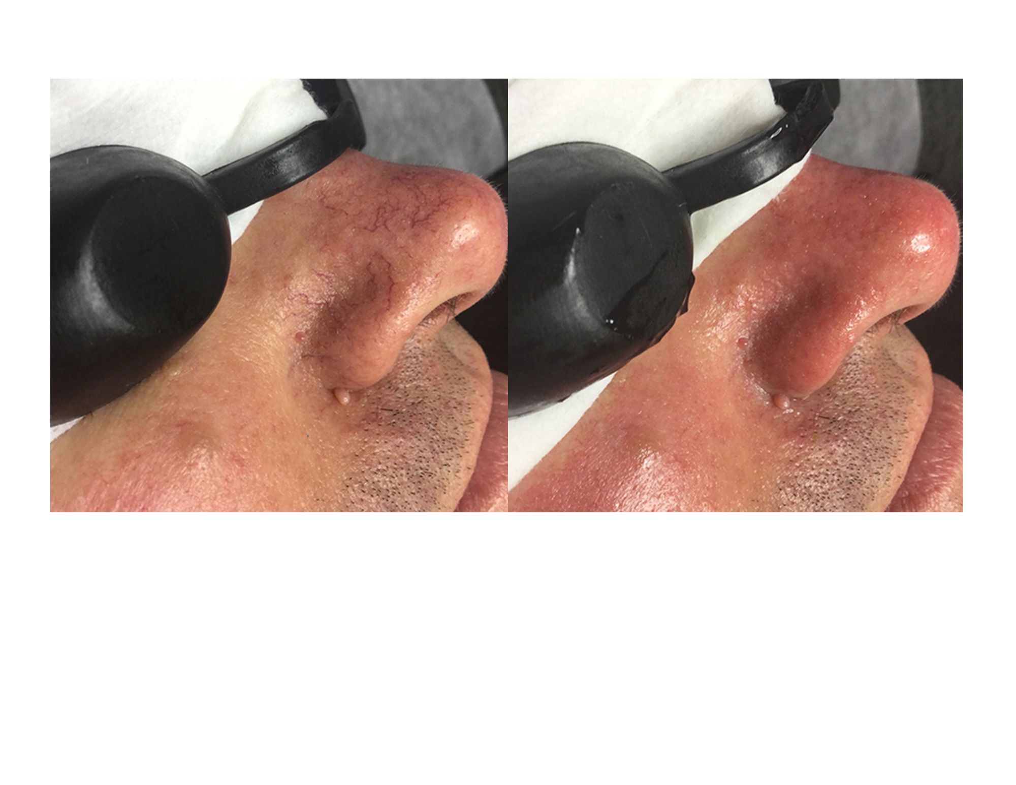 UltraLUX PRO IPL vascular treatment