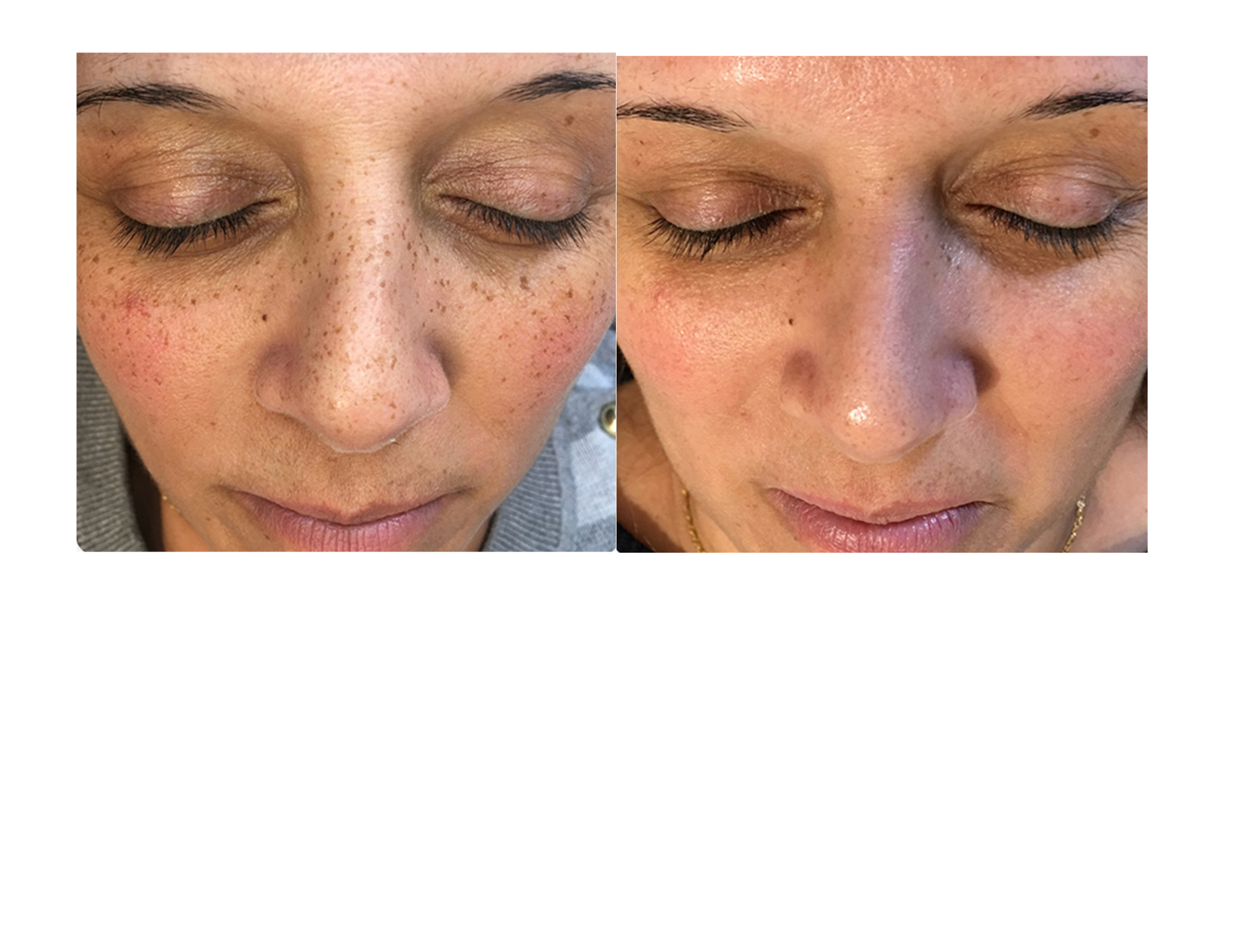 UltraLUX PRO IPL pigmentation treatment