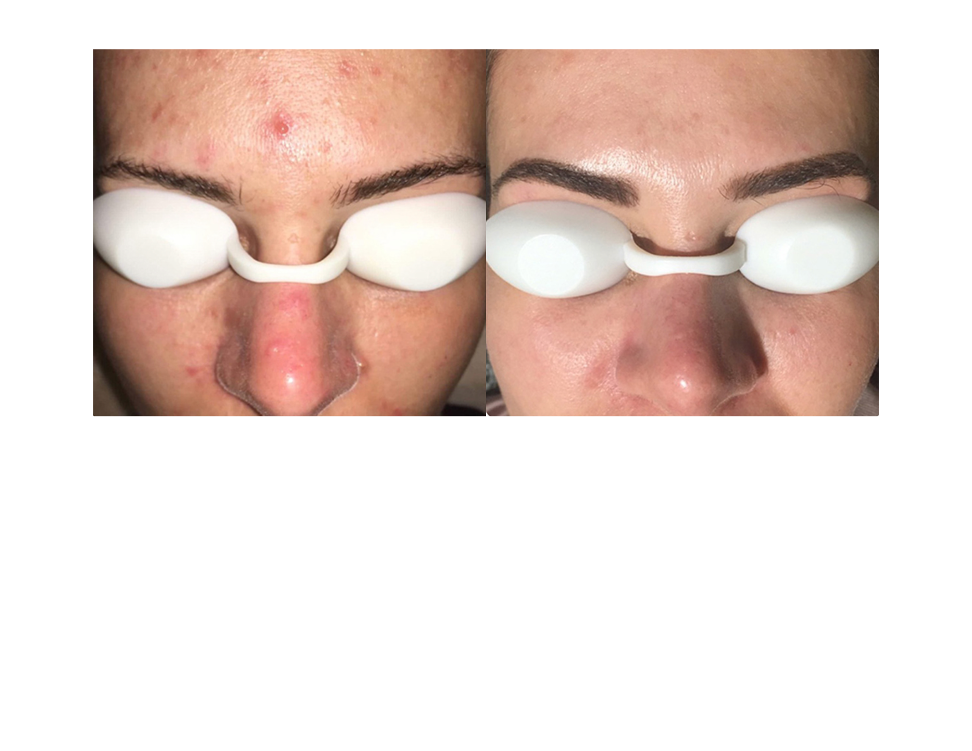 UltraLUX PRO IPL acne treatment