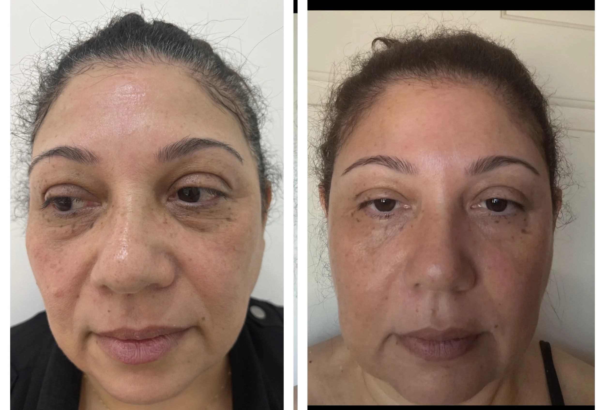 Plamere® plasma fibroblast results at Beauty Hub Sydney.