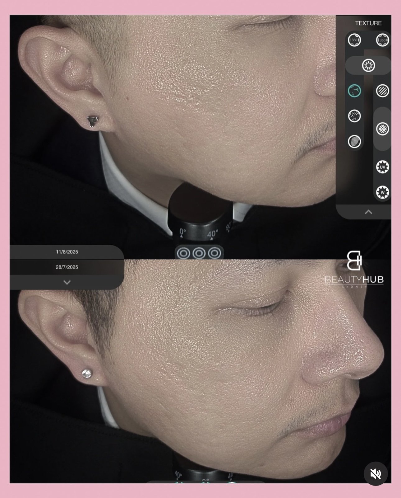 One month post Futera Dots resulted in smoother, more even skin tone under Observ imaging.