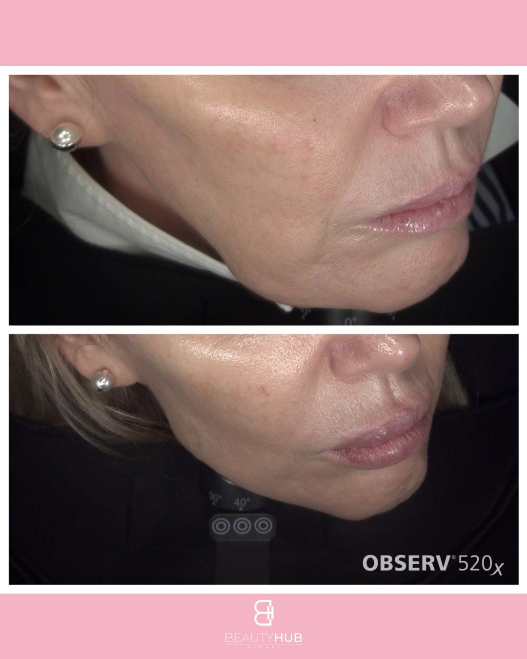 Jowl tightening Sydney Liftera HIFU result