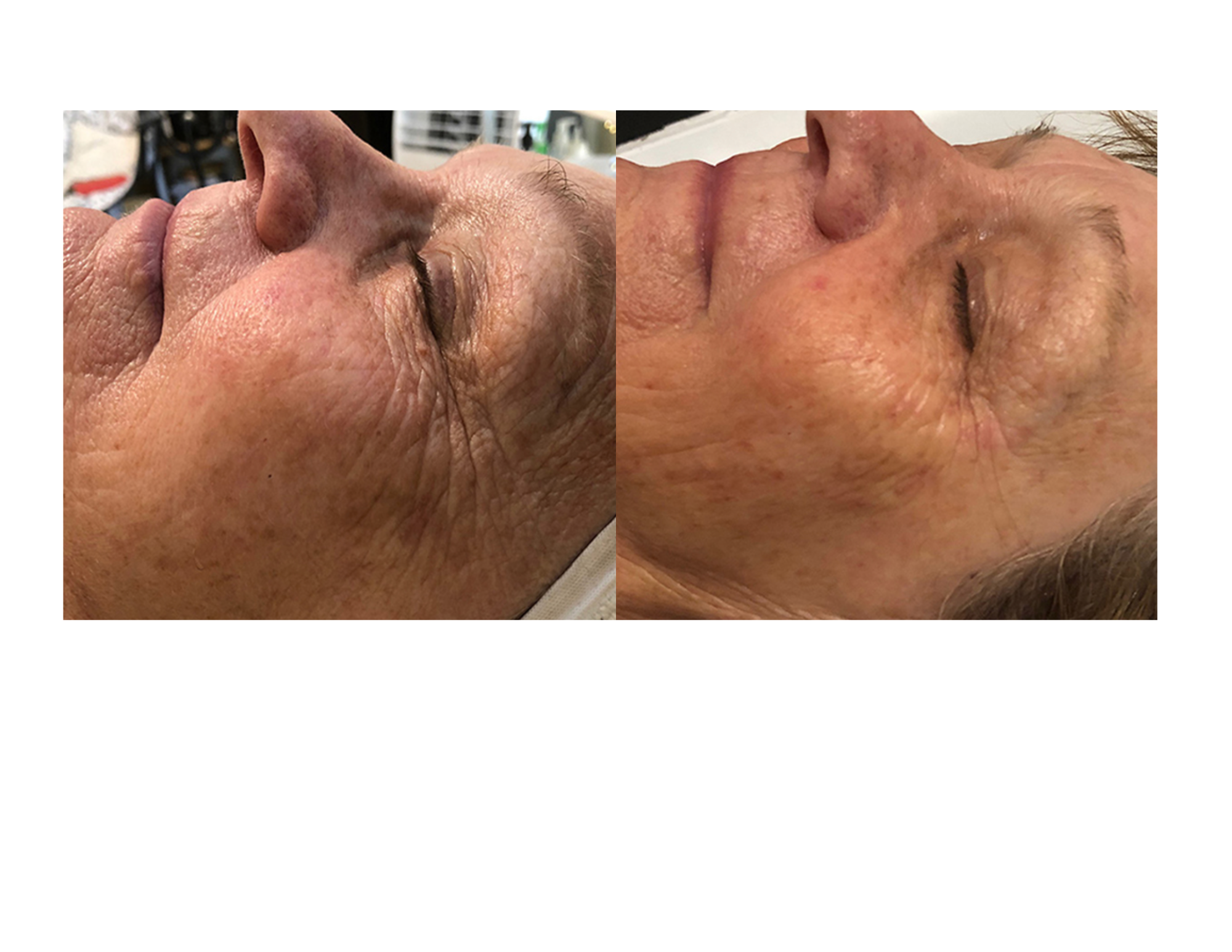 UltraLUX PRO IPL overview