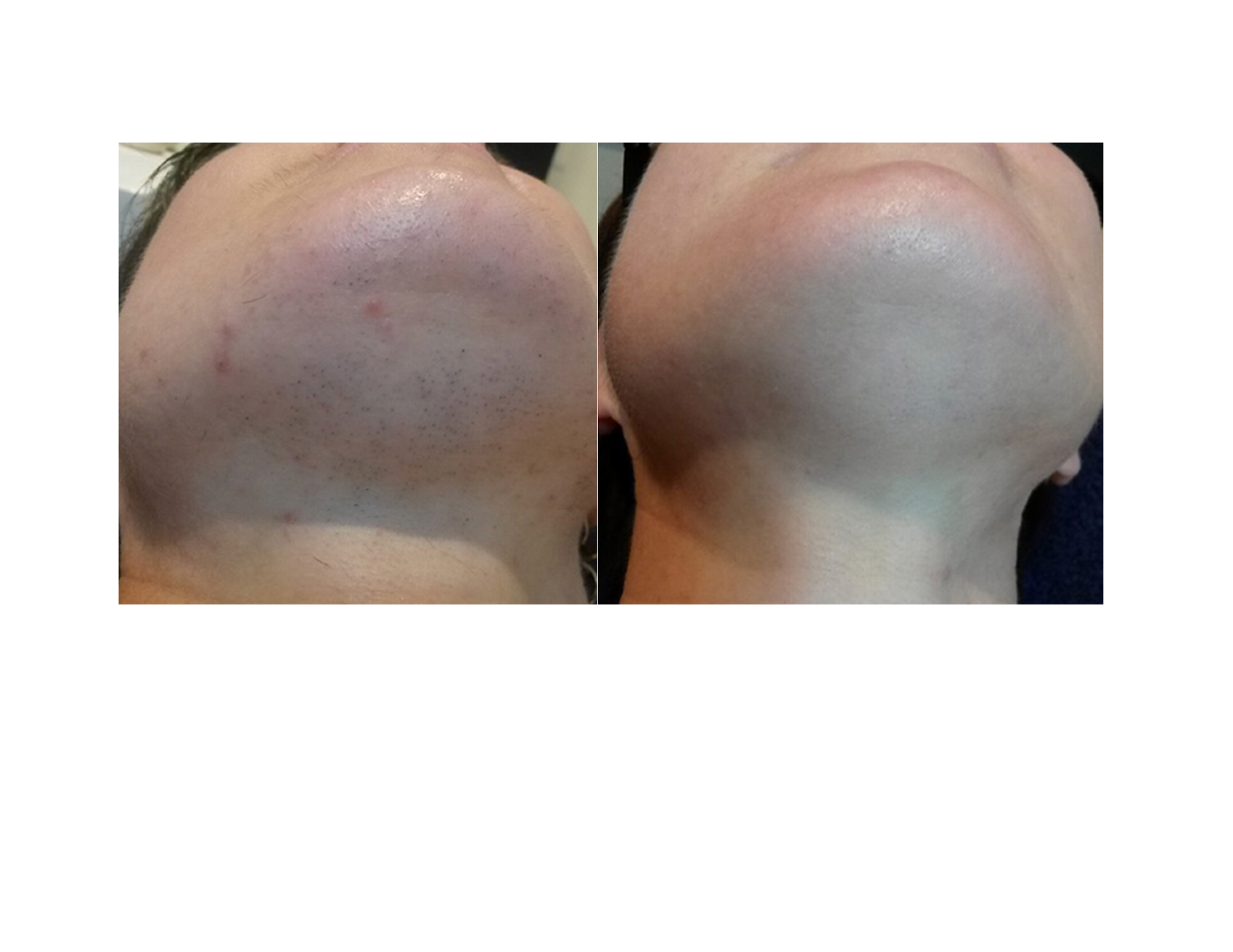 UltraLUX PRO IPL hair removal