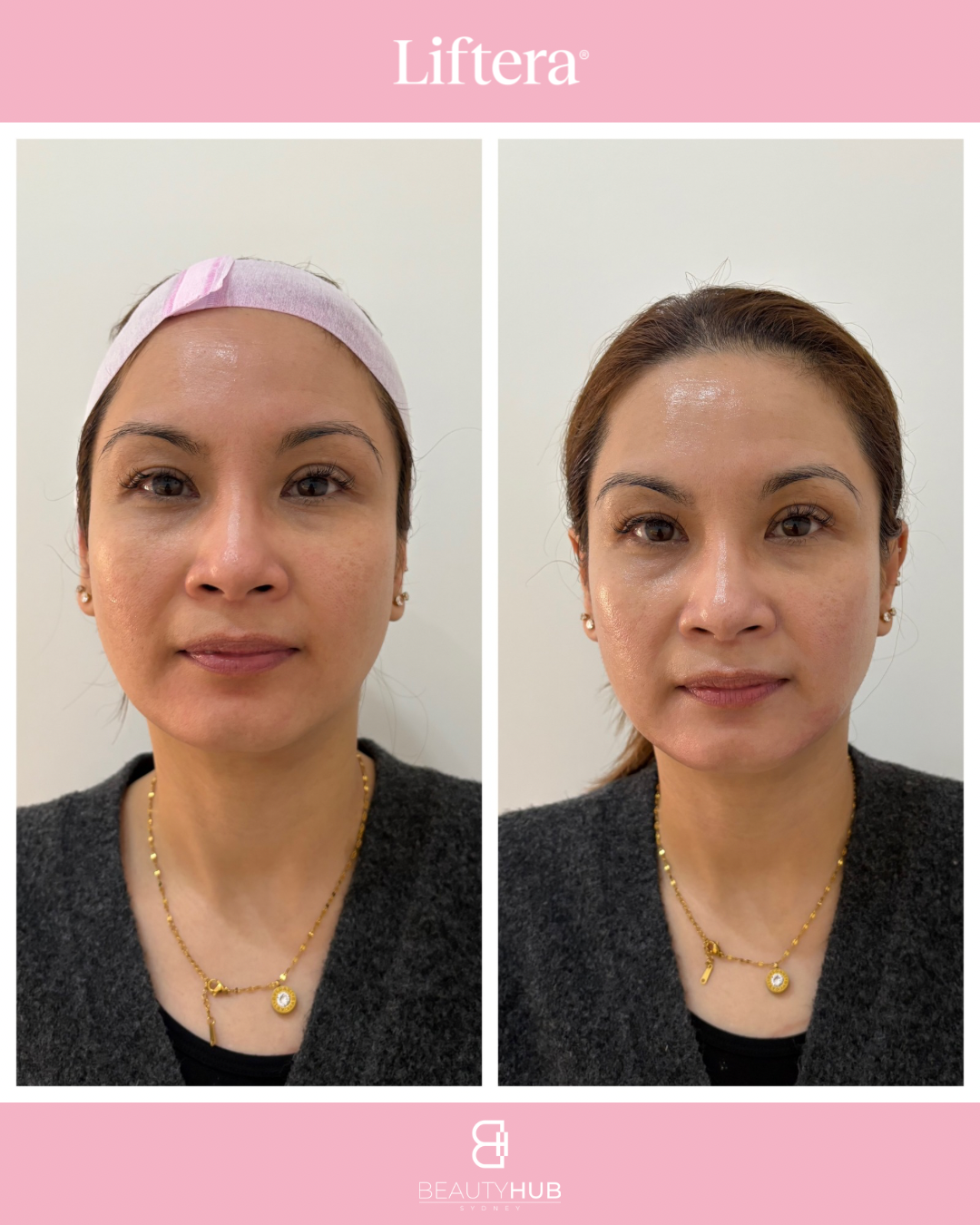 Liftera HIFU Sydney before after lower face lifting result