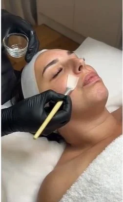 Close-up of a Larimedical Biomimetic Peel being applied at Glo Younger Perth