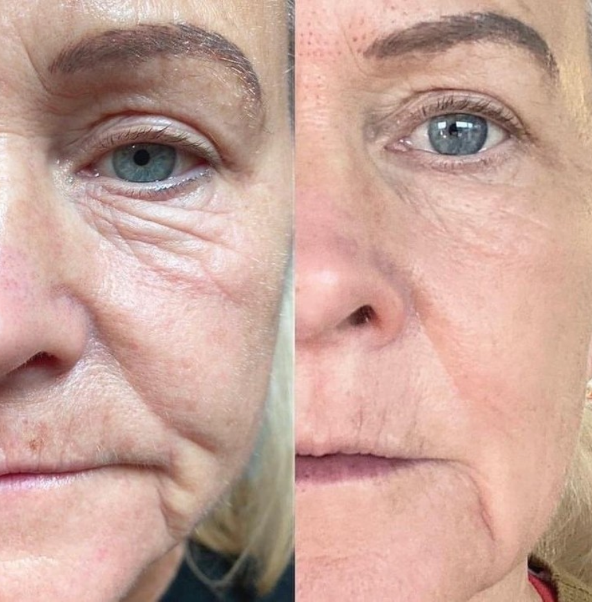 Plasma Fibroblast Eye Lift before and after at Glo Younger.