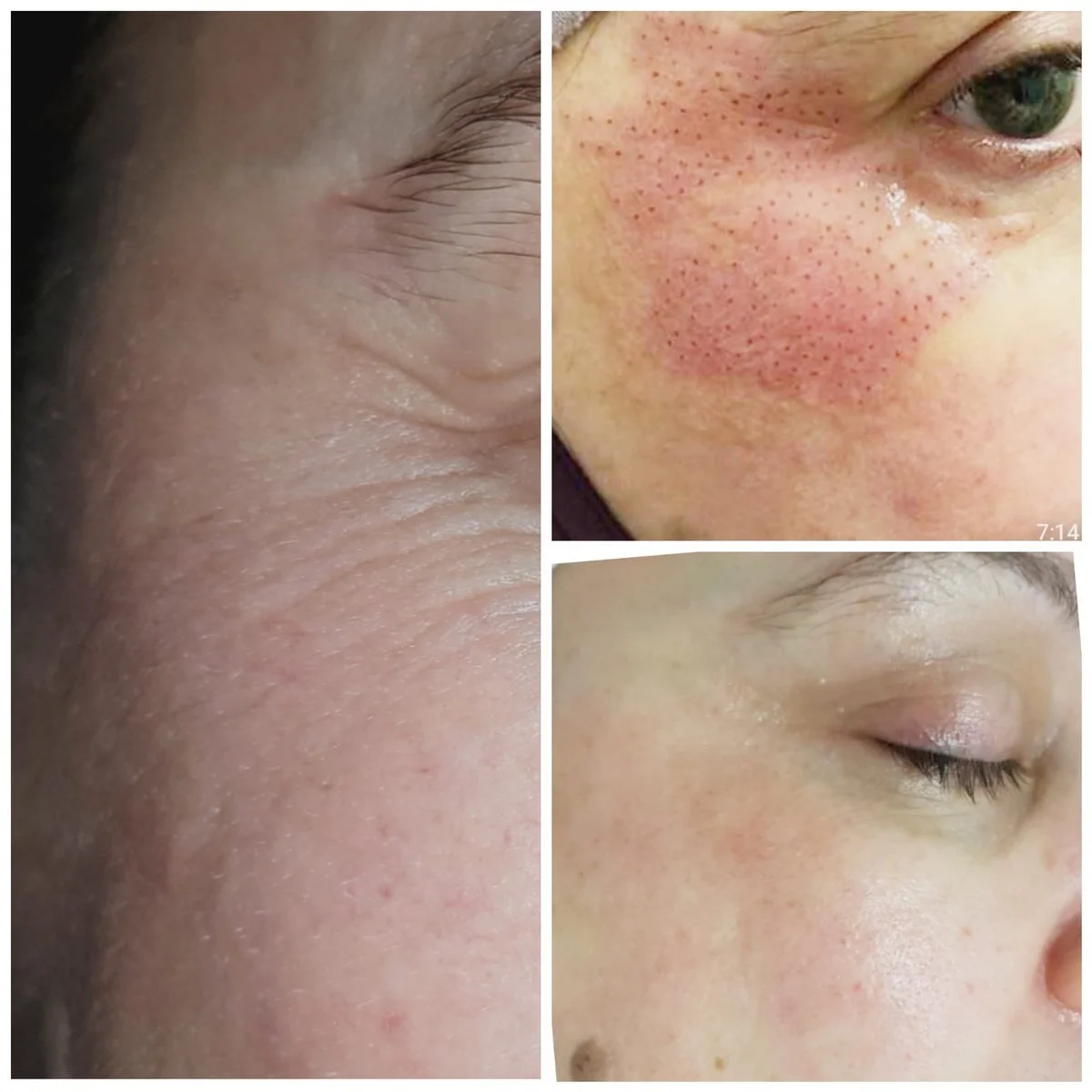 Close-up of the eye area during a Plasma Fibroblast Eye Lift at Glo Younger, showing the gentle plasma points pattern.