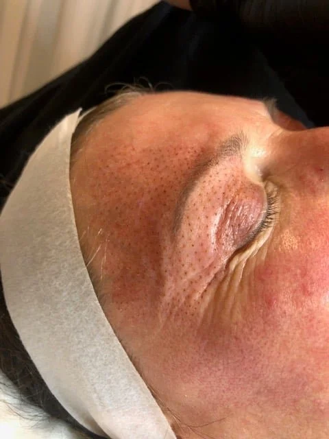The gentle plasma points pattern from a Plasma Fibroblast Eye Lift treatment at Glo Younger.