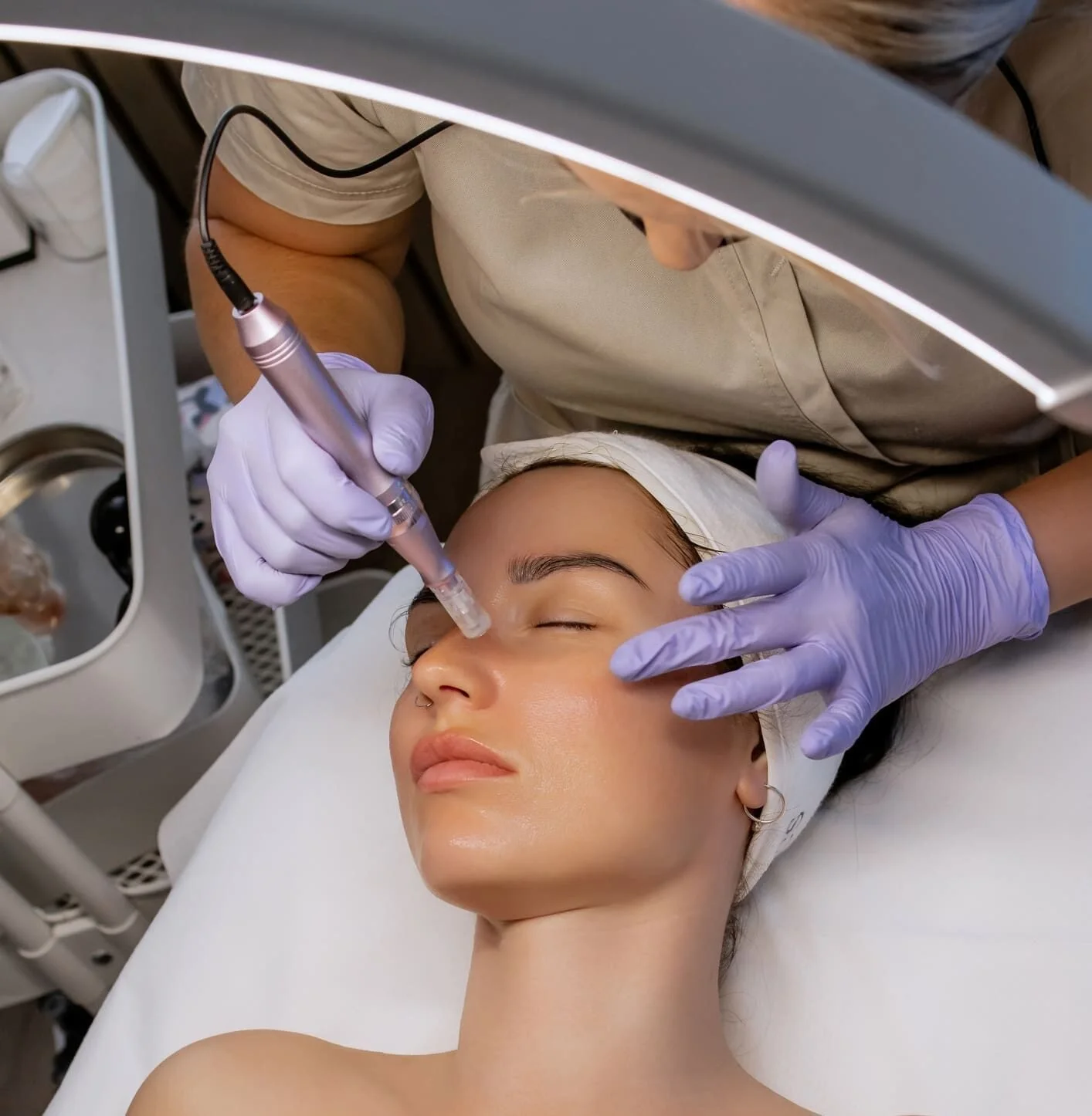 Microneedling treatment