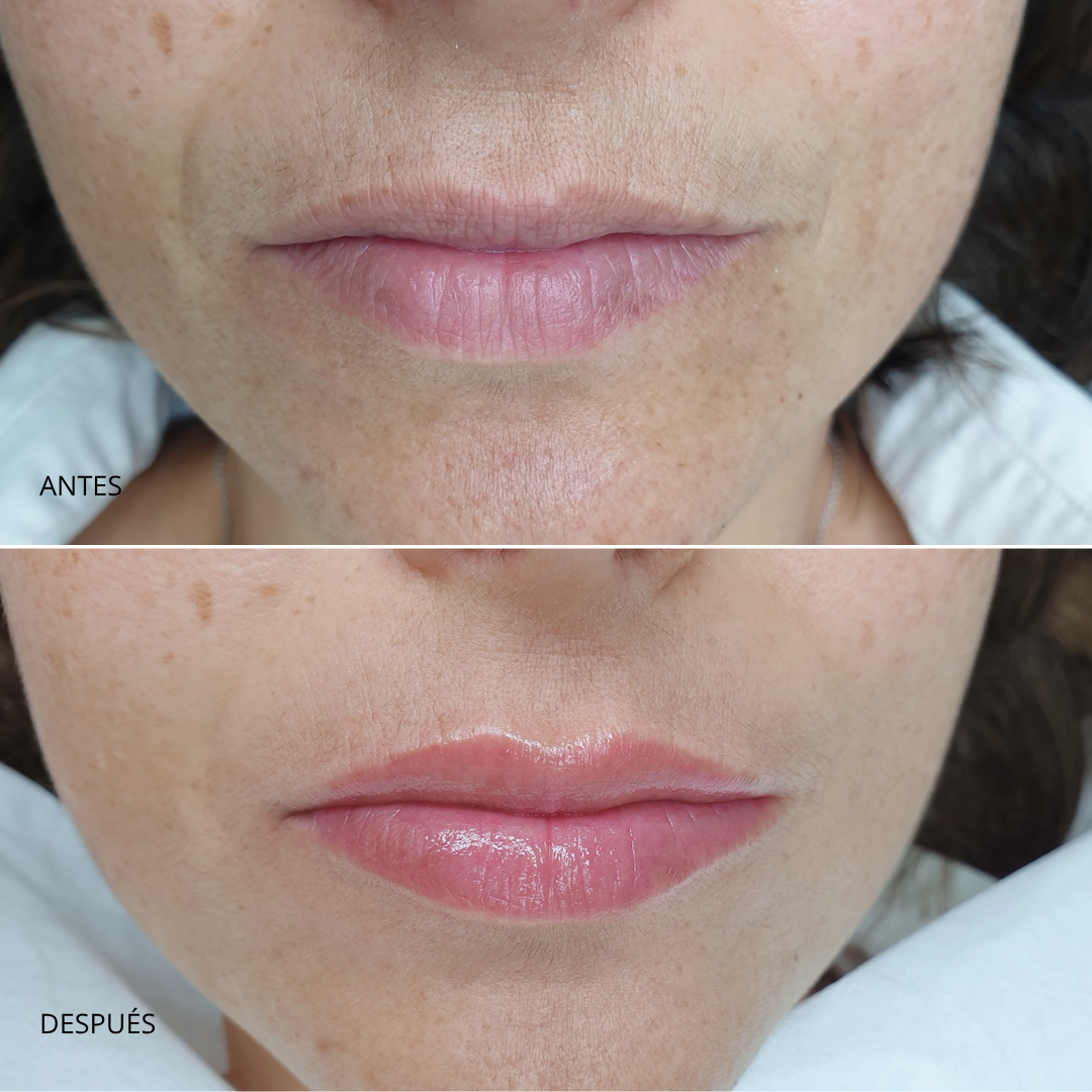 Antes y después Lip Touch